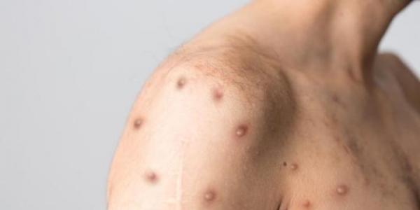 L'épidémie de la variole du singe