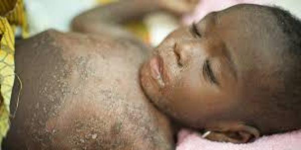 Un enfant souffrant de la rougeole 