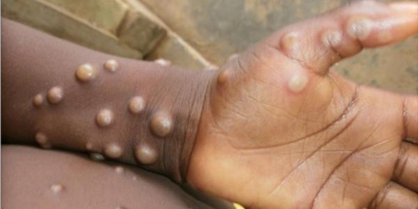 Un enfant atteint 