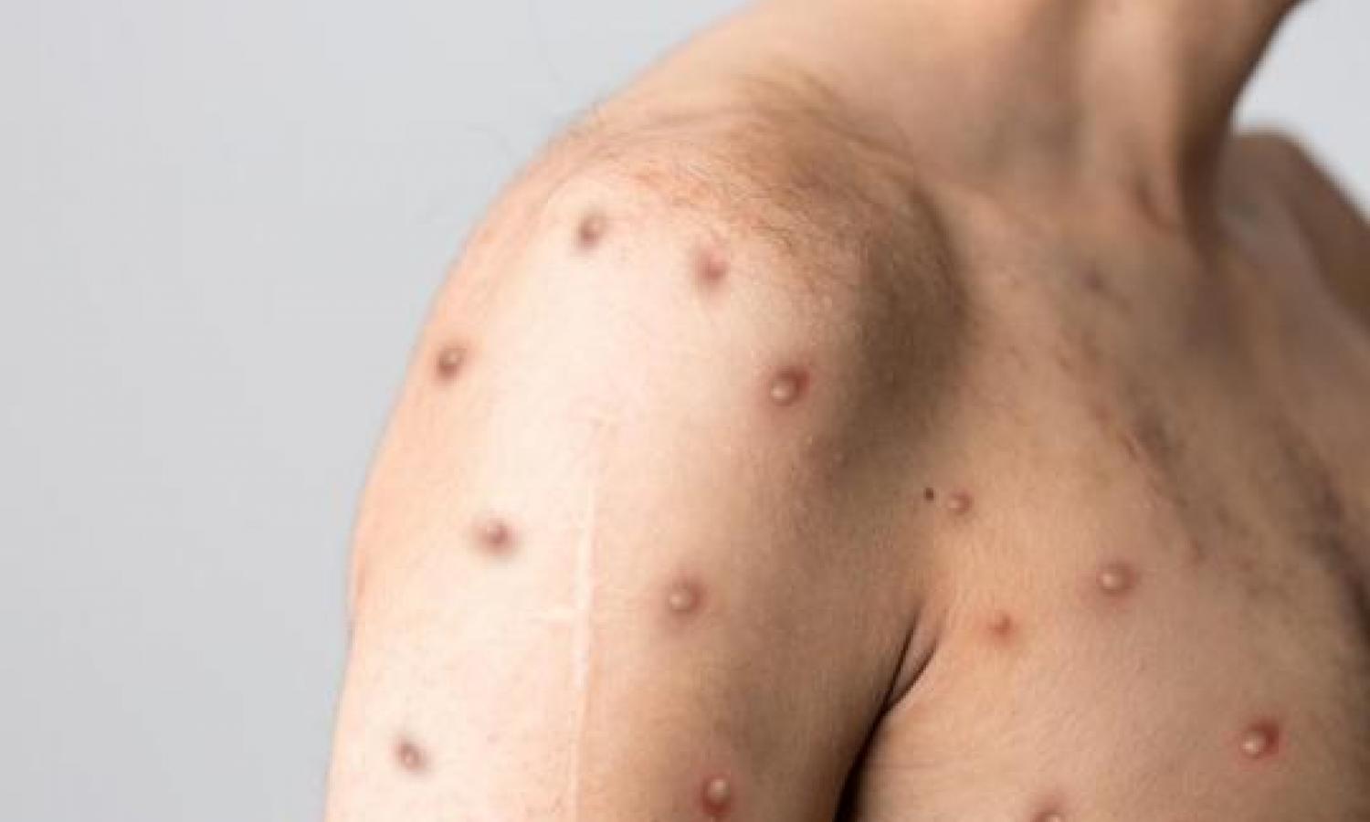 L'épidémie de la variole du singe