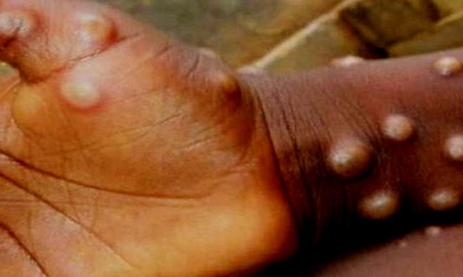 Un enfant atteint de la variole de siège 