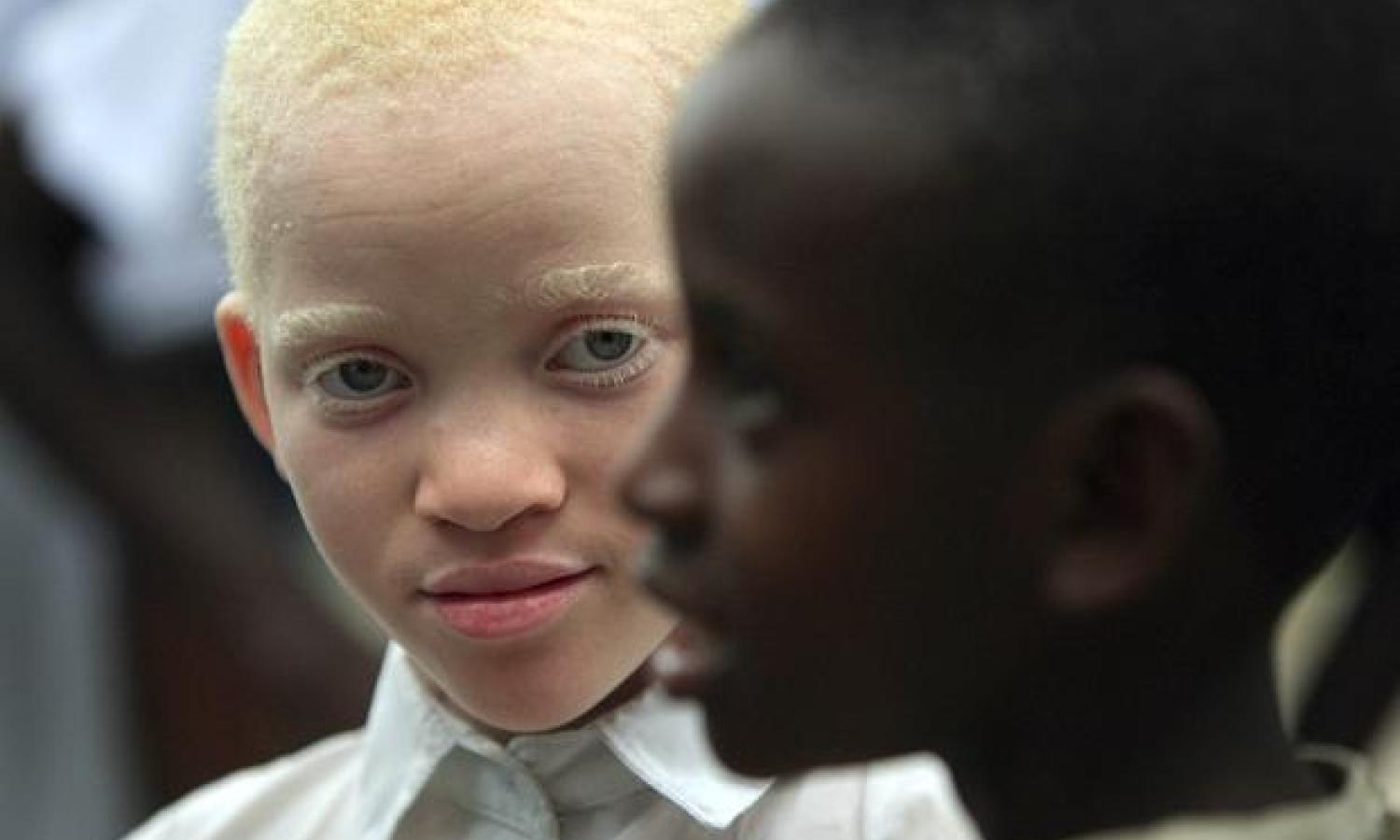 Deux enfants, l'un atteint d'albinisme 